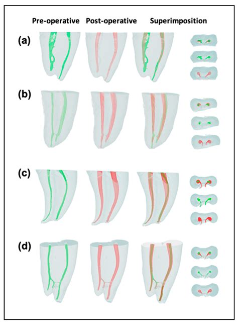 Influence of Coronal Flaring on the Shaping Ability of Two Heat-Treated Nickel-Titanium ...