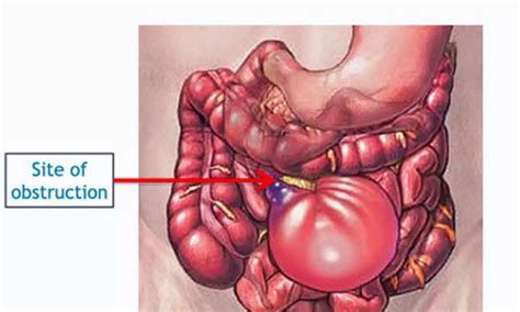 Laparoscopy Offers No Long-Term Edge Over Open Surgery in Small Bowel ...