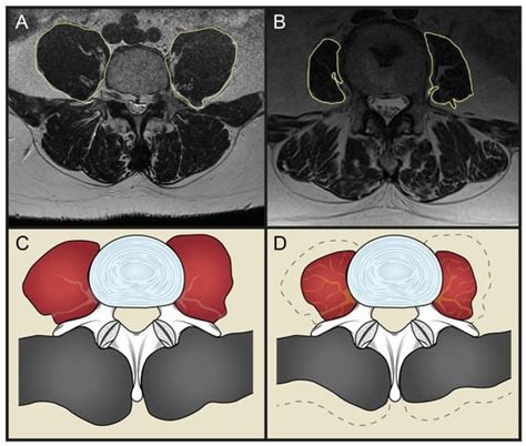Osteopenia and Sarcopenia as Potential Risk Factors for Surgical Site ...