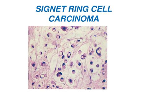 PPT - Understanding Gastric Carcinoma: Epidemiology, Pathogenesis & Classification PowerPoint ...