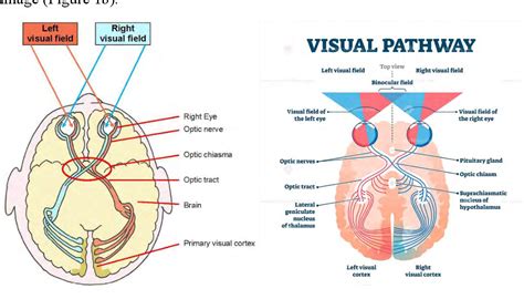 Image result for Contralateral Homonymous Hemianopsia