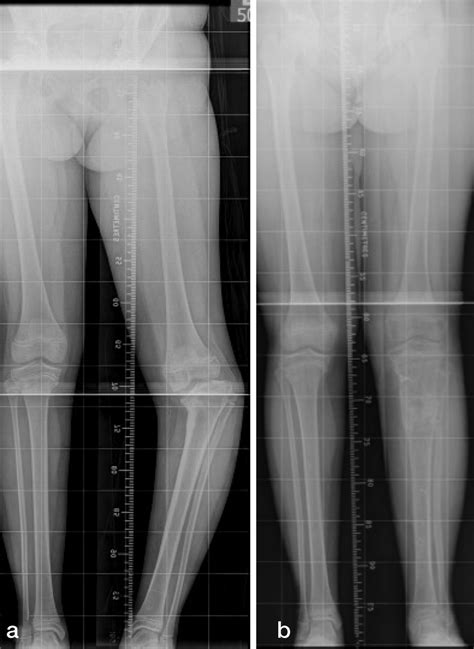 Image result for Normal Leg Alignment