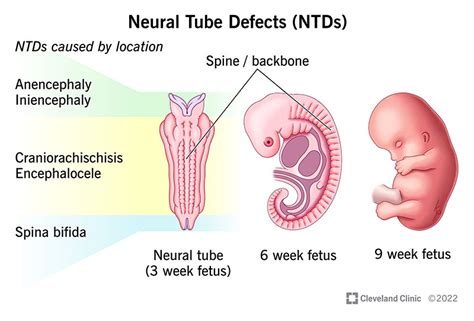 Image result for Neural Tube Defects Causes