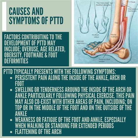 What Is Adult Acquired Flat Foot AKA Posterior Tibial Tendon Dysfunction? - Brisbane ...