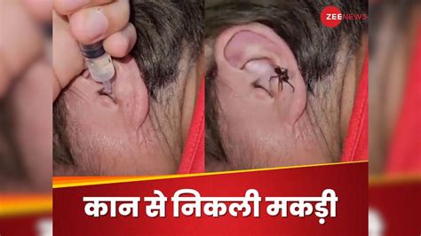 spider enters in the ear while sleeping doctor treatment viral | सोते ...