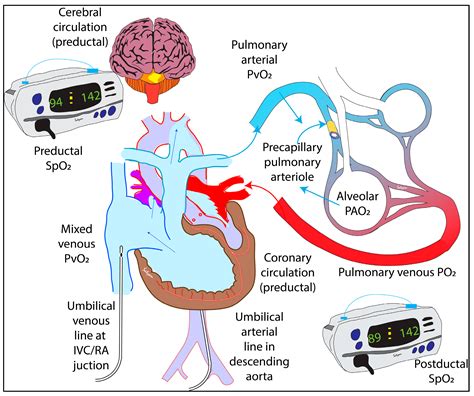 How Do We Monitor Oxygenation during the Management of PPHN? Alveolar ...