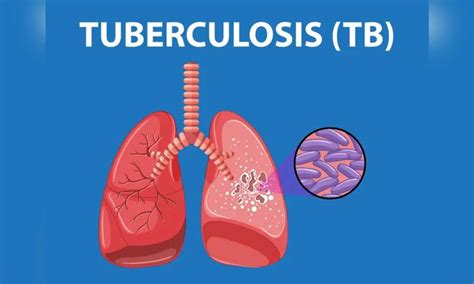 Jewellery, decorative item makers at high latent TB risk from silica ...