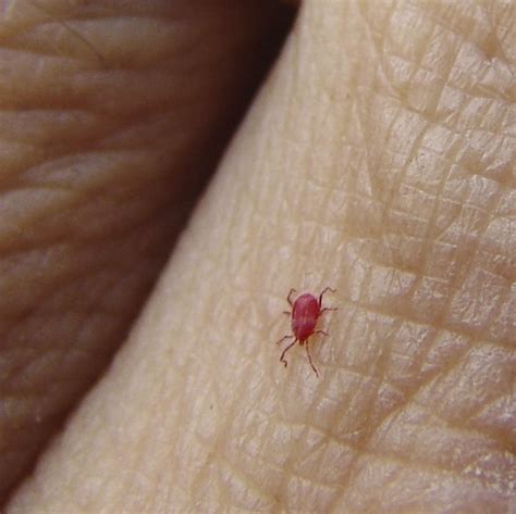 Chigger Bug Bites First Aid Treatment For Chiggers HSI