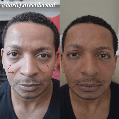Upper Cheek Filler Cheek Fillers Before And After Photos At Flawless