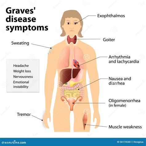 Graves Disease