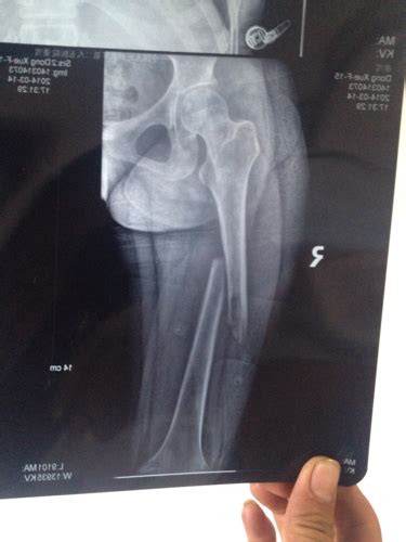 我孩子 大腿骨折 做手术 拍片子 骨头上明显 挖了。医生说 是骨头 被吸收。我该怎么办。去那医院看_百度知道