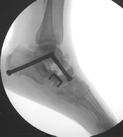 Triple arthrodesis: is bone grafting necessary? | Bone & Joint