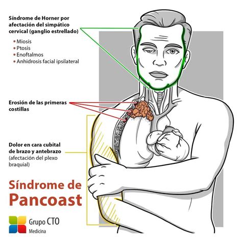 Sx. de Pancoast | Neurología