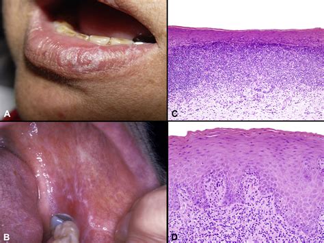 Lichen planus and lichenoid dermatoses - Journal of the American Academy of Dermatology