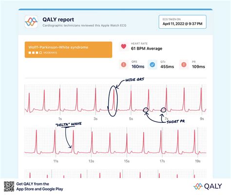 Wolff parkinson white syndrome – Artofit