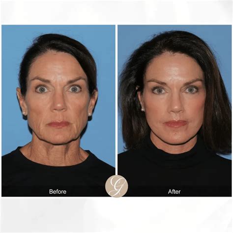Deep Plane Face Lift Nedir? Fiyatları, Öncesi Sonrası, Etkileri Ve Tüm Detaylar