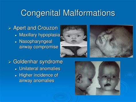 Image result for Neonatal Intubation Procedure