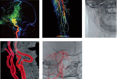 Двопроекційна ангіографічна система з унікальною С-аркою Alphenix Biplane