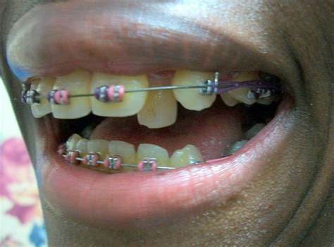 Metal mouth brace face blog