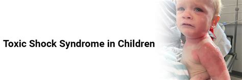 Toxic Shock Syndrome in Children
