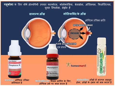 ग्लूकोमा के लक्षण और होम्योपैथी उपचार – Homeopathy Hindi