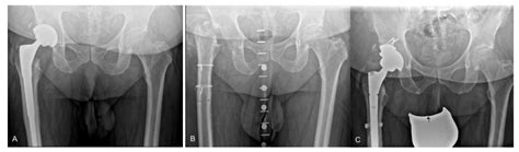 Extended Trochanteric Osteotomy with Intermediate Resection ...