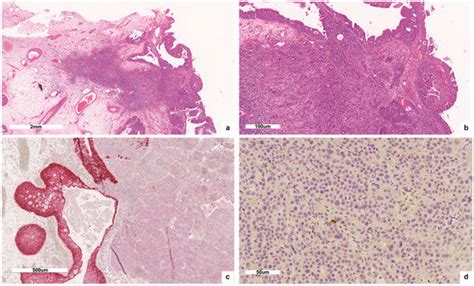 HPV Virus Transcriptional Status Assessment in a Case of Sinonasal ...