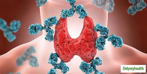 What Is Hashimoto Thyroiditis Know Perfect Diet And Lifestyle Hack from ...