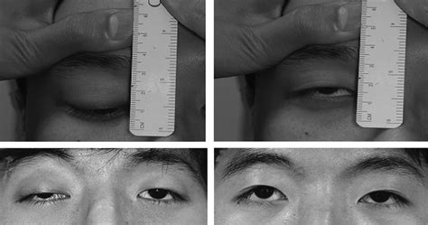 Image result for Levator Resection Surgery