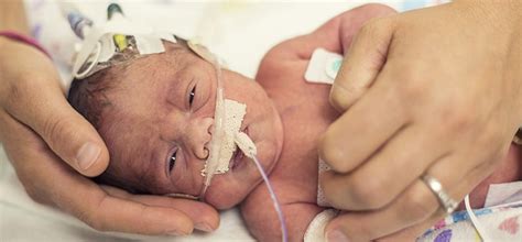 Congenital asphyxia - Giggles - Giggles