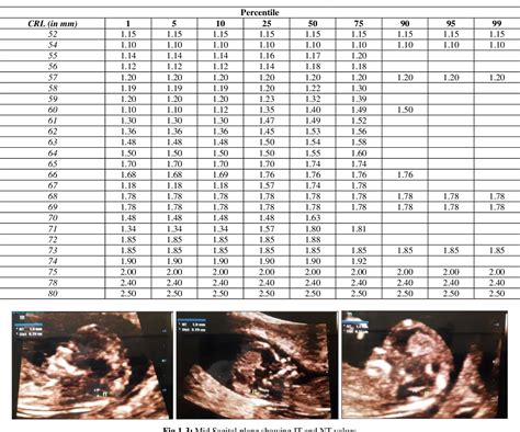Figure 1-3 from Normal intracranial translucency values during first trimester gestation in ...