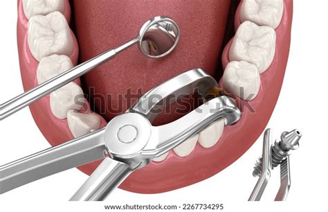 Image result for What Is a Complex Tooth Extraction
