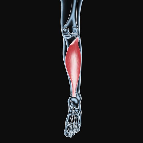 Soleus Muscle Injury Symptoms