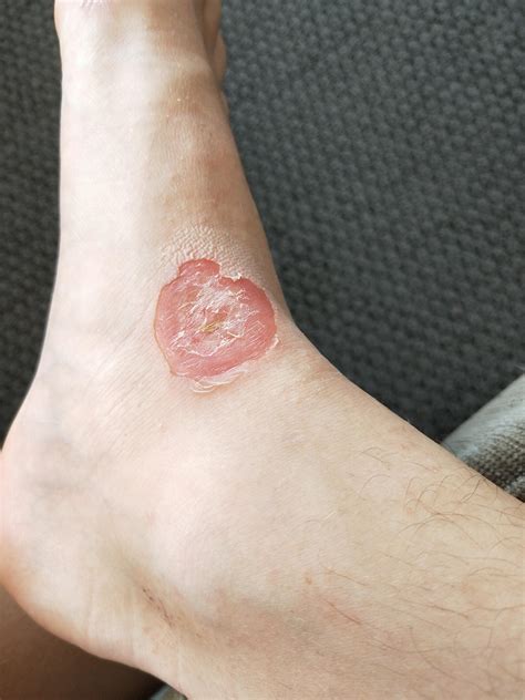 I got a huge blister on my foot that's infected with staph (I have been ...
