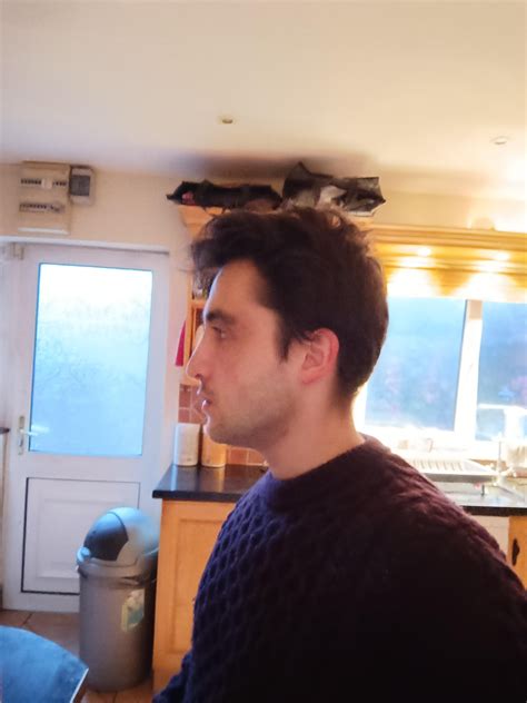 Is my mandible small/recessed? Do I have short face syndrome, or am I hyper-divergent? : r ...