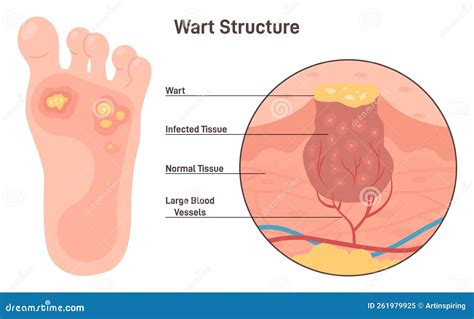 Human Papillomavirus Infection On Foot