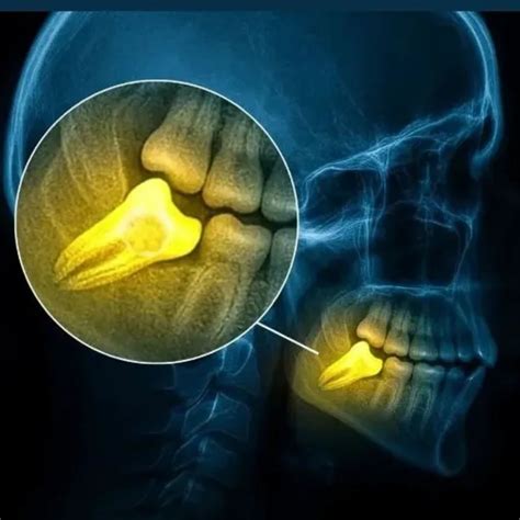 How Long Swelling Lasts After Wisdom Tooth Surgery in Mumbai