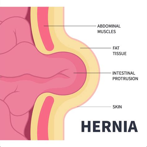 Hernia: Causes, Risk Factors, Symptoms, Treatment