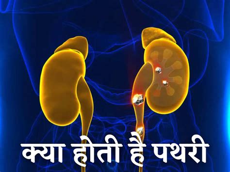 क्यों होती है पथरी की समस्या और कौन सी दवा है फायदेमंद? जानें - problem ...