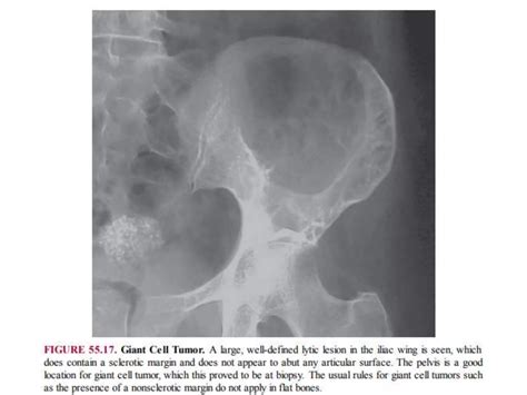 Lytic lesions of bone | PPTX