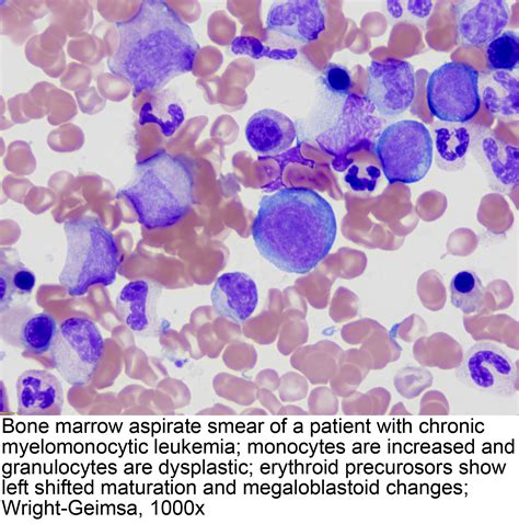 Absolute Immature Granulocytes Leukemia at Aiden Scurry blog