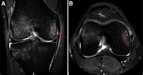 High Prevalence of Superficial and Deep Medial Collateral Ligament ...