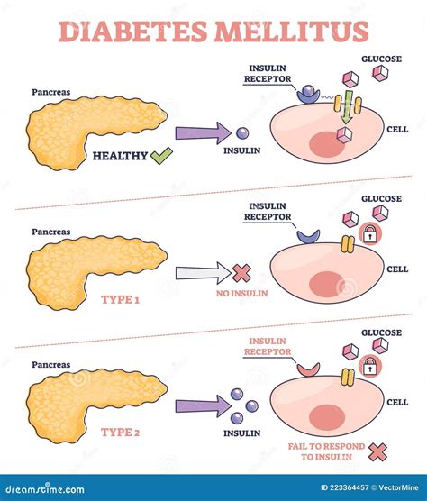 Pancreas Diabetes Diagram