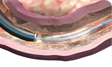 Endoscopic DMR may eliminate need for insulin to control blood sugar in ...