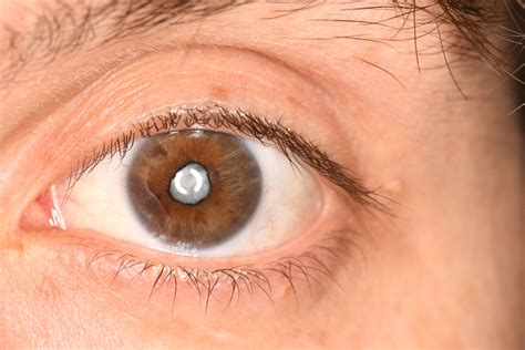 Kuvatulokset haulle cataract