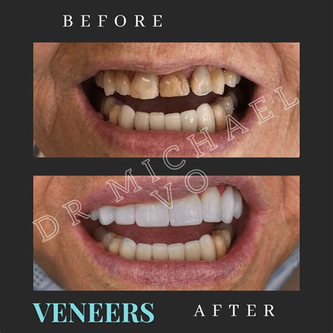 Cosmetic Veneers - West Island Dental Clinic
