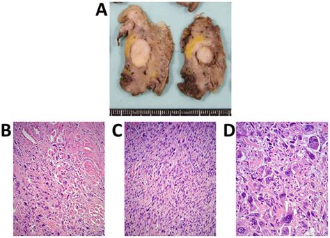 Spindle Cell Sarcoma Treatment at Victoria Jenkins blog