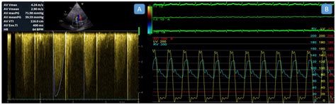 Comparison of Echocardiography and Invasive Transseptal Catheterization ...