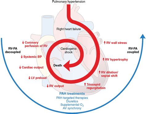 Evaluation and Management of Pulmonary Hypertension in Noncardiac ...