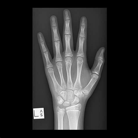 Top 93+ Pictures Normal X-ray Of Hand And Wrist Sharp